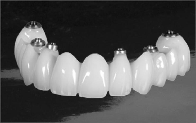 Протезирование при отсутствии многих или всех зубов